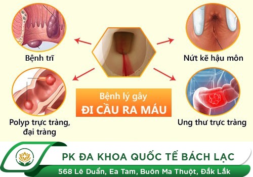 Đi Cầu Ra Máu Là Mắc Bệnh Gì