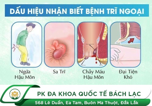 Bệnh Trĩ Ngoại Có Lây Không?
