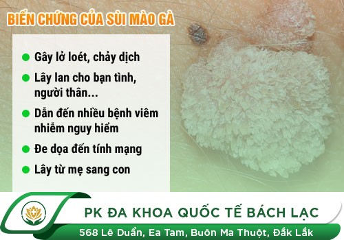Hình Ảnh Nhận Biết Sùi Mào Gà Ở Lỗ Sáo Và Cách Chữa An Toàn