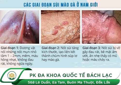 Bệnh Sùi Mào Gà Giai Đoạn Đầu Có Biểu Hiện Như Thế Nào