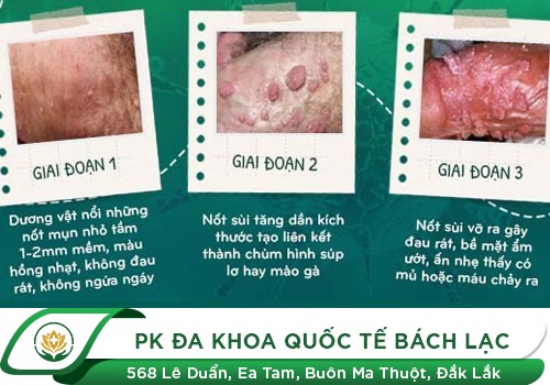 Một Số Hình Ảnh Về Sùi Mào Gà