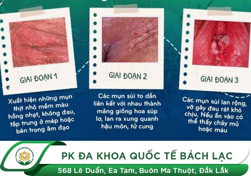 Biểu Hiện Sùi Mào Gà Âm Đạo Không Thể Bỏ Qua