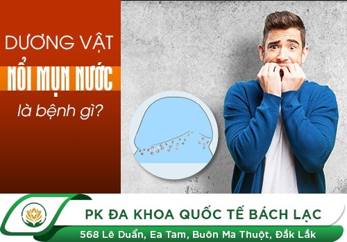 Cu Nổi Mụn Nước Thì Phải Làm Sao