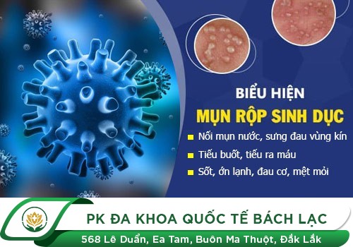 Triệu Chứng Của Bệnh Mụn Rộp Sinh Dục