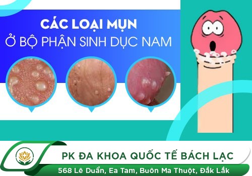 Tinh hoàn nổi mụn - Cảnh báo bệnh lý gì?