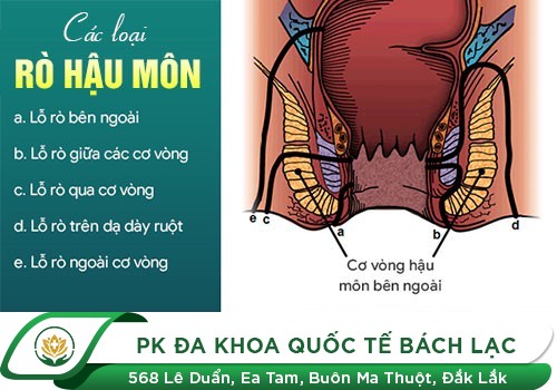 Triệu chứng nhận biết bệnh rò hậu môn