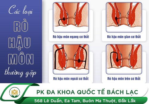 Hình Ảnh Rò Hậu Môn
