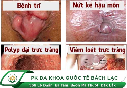 Nứt hậu môn, rách hậu môn - dấu hiệu của nhiều bệnh lý
