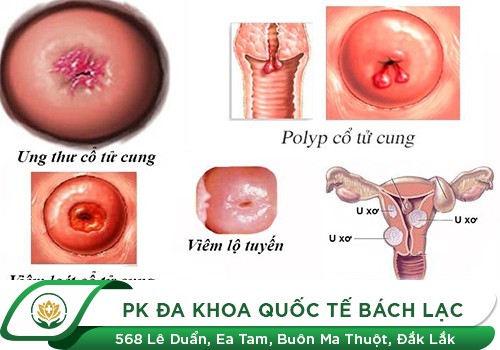 Cẩn thận Những căn bệnh tử cung gây vô sinh ở nữ giới