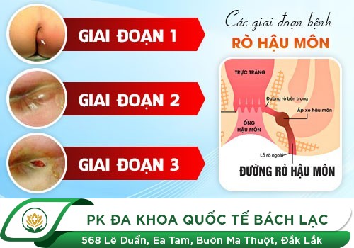 Nứt hậu môn, rách hậu môn - dấu hiệu của nhiều bệnh lý