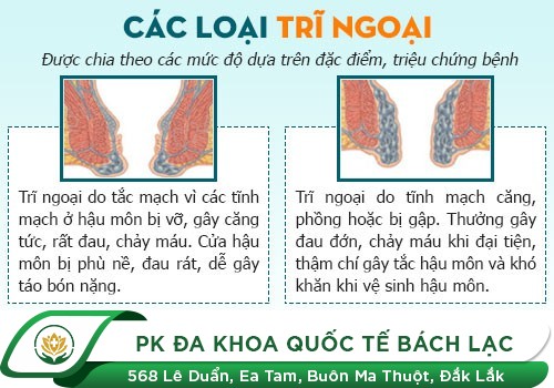 Một Số Hình Ảnh Của Bệnh Trĩ Qua Từng Giai Đoạn