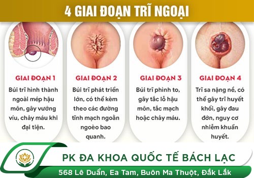 Những Biểu Hiện Của Bệnh Trĩ Ngoại