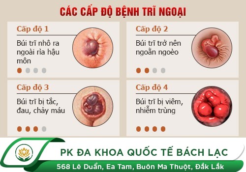 Triệu Chứng Của Bệnh Trĩ Ngoại