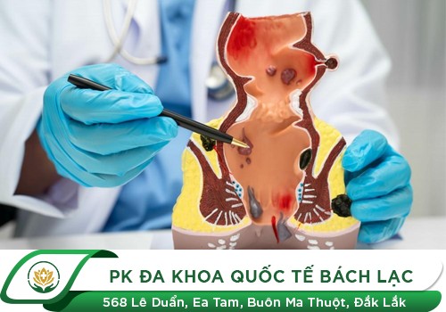 Các cấp độ của bệnh trĩ
