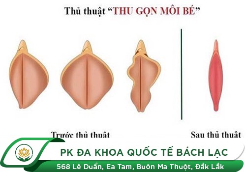 Khi Nào Cần Cắt Môi Âm Đạo? Bác Sĩ Thẩm Mỹ Phụ Khoa Đưa Ý Kiến