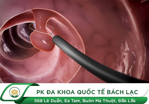 Những phương pháp điều trị Polyp cổ tử cung hiệu quả hiện nay
