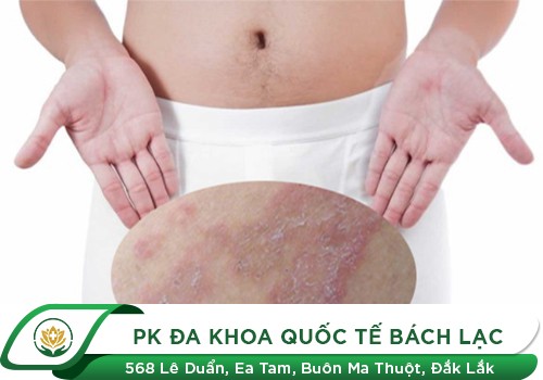 Nổi Mẩn Đỏ Quanh Bao Quy Đầu Là Dấu Hiệu Của Bệnh Gì