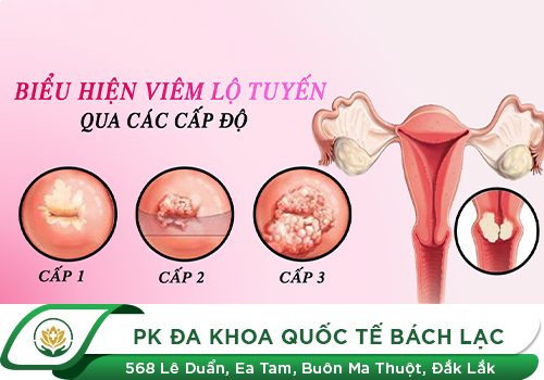 Viêm lộ tuyến độ 2 có nguy hiểm không