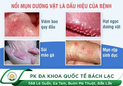 Nổi Mụn Dương Vật Là Triệu Chứng Bệnh Gì?