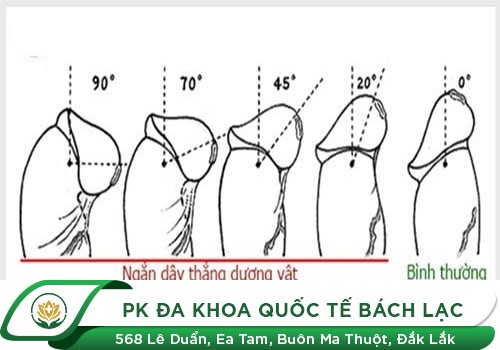 Đứt Dây Hãm Bao Quy Đầu Và Những Tác Hại Nam Giới Cần Biết