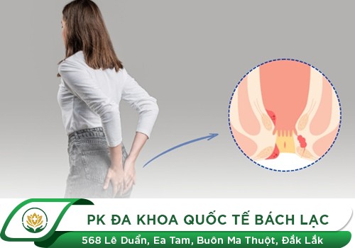 Điều trị sa búi trĩ tại phòng khám Đa Khoa Quốc Tế Bách Lạc