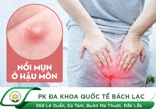 Hậu môn nổi mụn lạ triệu chứng của bệnh gì?