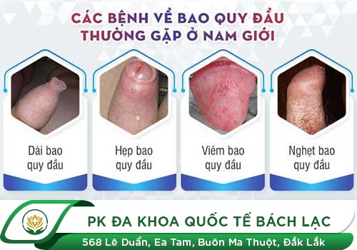 Bệnh Liên Quan Đến Quy Đầu - Biết Sớm Tránh Nhanh