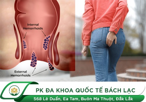 Lồi con trê là bệnh gì?