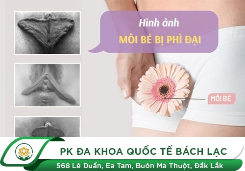 Hình Ảnh Môi Bé Phì Đại Gây Ảnh Hưởng Thẩm Mỹ Và Sinh Hoạt