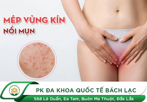 Nổi mụn ở mép vùng kín nữ - 8 nguyên nhân phổ biến và cách trị