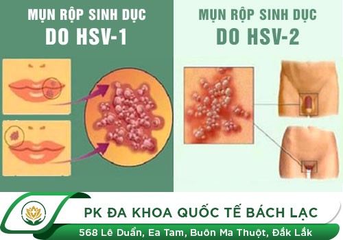 Herpes Là Gì? Cách Điều Trị Hiệu Quả