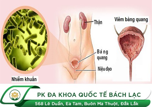 7 dấu hiệu bạn phải đi khám bàng quang trước khi quá muộn