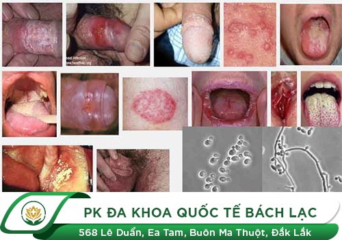 Hình ảnh nấm Candida ở nam giới và nữ giới