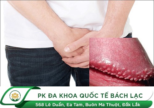 dương vật nổi mụn li ti