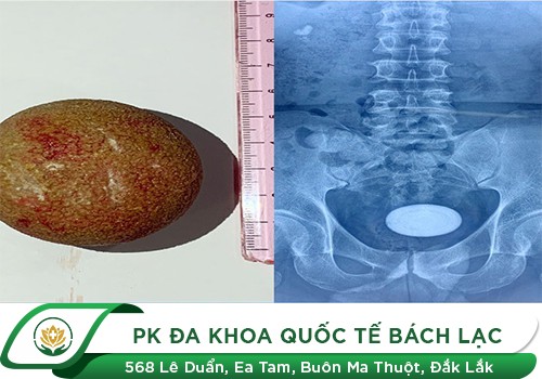 Đau bàng quang do sỏi bàng quang
