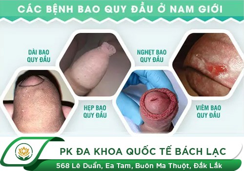 Bệnh lý bao quy đầu ở nam giới thường gặp