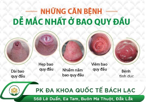 Đâu là lí do khiến dương vật sưng phù?