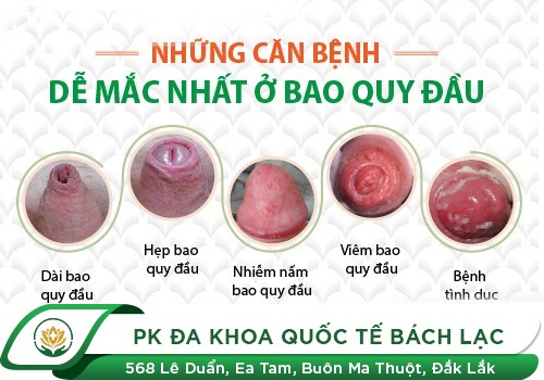 Dài hoặc hẹp bao quy đầu
