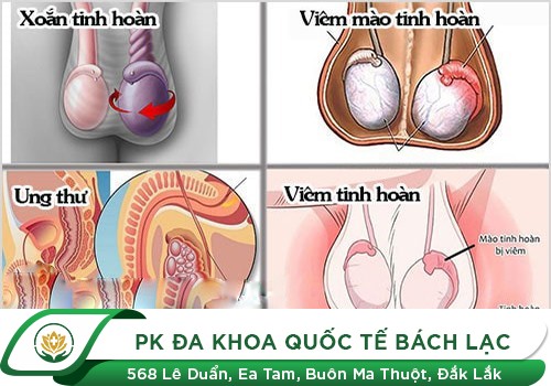 Sưng Tinh Hoàn Là Dấu Hiệu Của Bệnh Gì