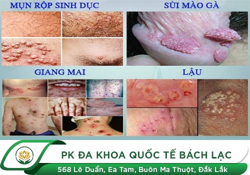 hình ảnh bệnh nam khoa
