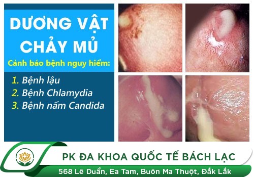 Bệnh sinh dục khiến dương vật ra dịch trắng đục bất thường!