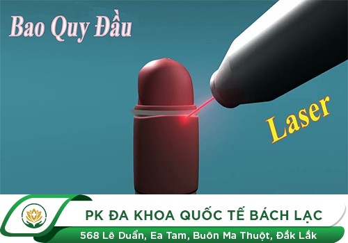 Phương pháp cắt bao quy đầu khác