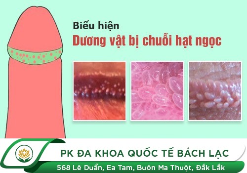 Dương Vật Nổi Mụn Lạ, Liệu Tôi Đã Mắc Bệnh Gì