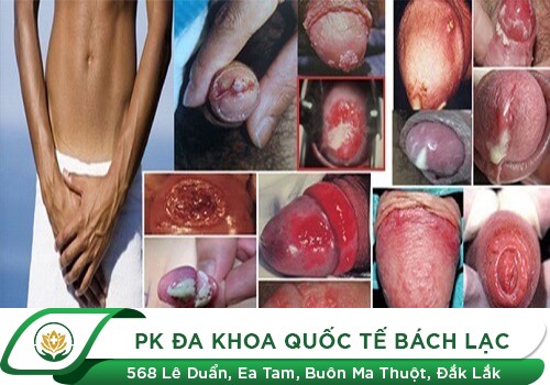 Một số hình ảnh về bệnh nguy hiểm ở lỗ sáo và dấu hiệu nhận biết