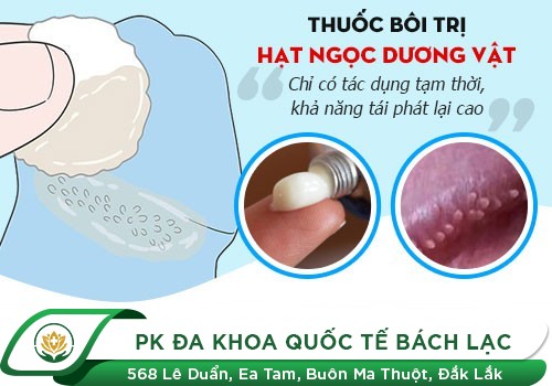 Đâu là giải pháp cho tình trạng xuất hiện hạt trắng dưới bao quy đầu ở nam giới 