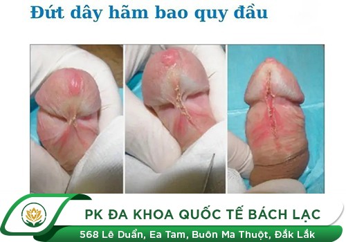 Dây Hãm Bao Quy Đầu Và Cách Điều Trị Khi Đứt Dây Hãm Bao Quy Đầu