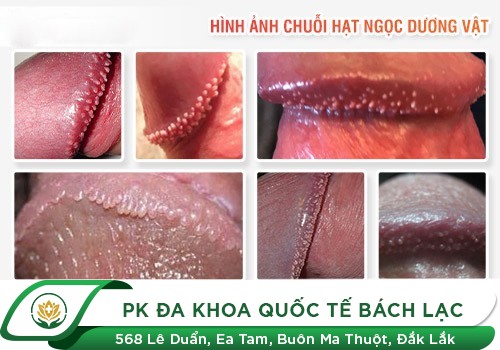Chuỗi hạt ngọc dương vật là gì?
