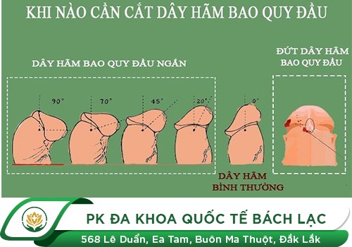DÂY HÃM BAO QUY ĐẦU LÀ GÌ