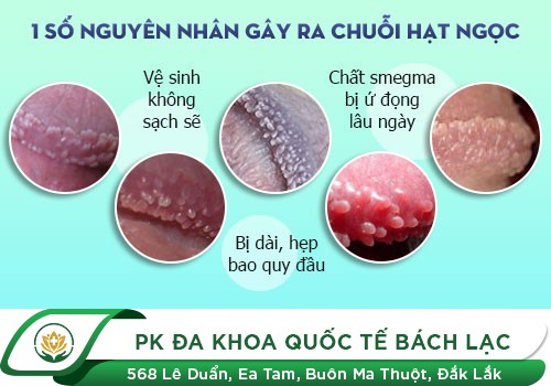 Cách Nhận Biết Và Điều Trị Chuỗi Hạt Ngọc Dương Vật