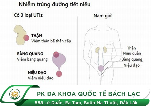 Những Điều Cần Biết Về Bệnh Nhiễm Trùng Đường Tiểu Ở Nam Giới